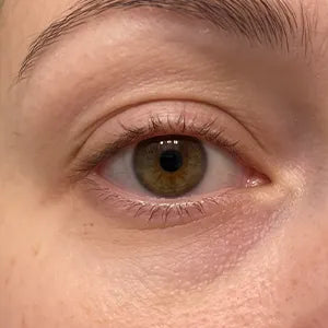 Close-up of the same eye at week one, before starting the serum