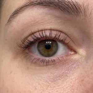 The same eye at week three
